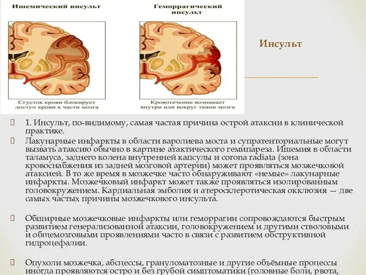 1. Инсульт, по-видимому, самая частая причина острой атаксии в клинической практике. Лакунарные инфаркты