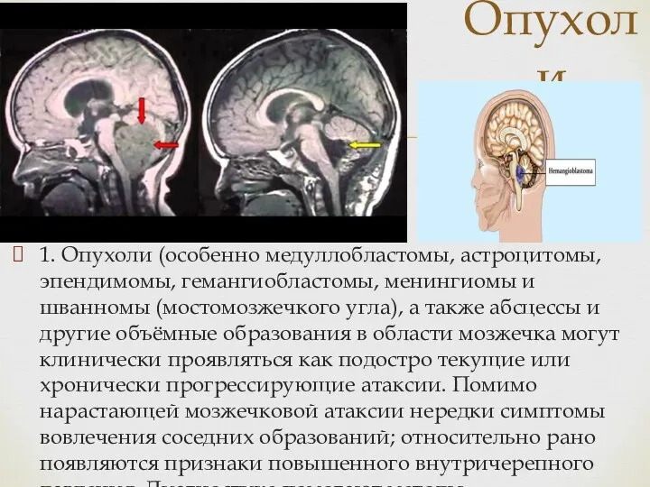 1. Опухоли (особенно медуллобластомы, астроцитомы, эпендимомы, гемангиобластомы, менингиомы и шванномы