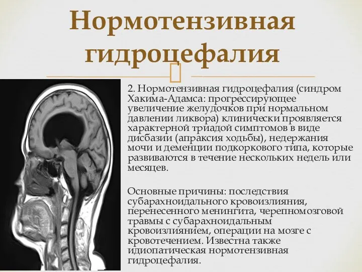 2. Нормотензивная гидроцефалия (синдром Хакима-Адамса: прогрессирующее увеличение желудочков при нормальном давлении ликвора) клинически