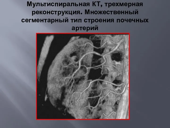 Мультиспиральная КТ, трехмерная реконструкция. Множественный сегментарный тип строения почечных артерий