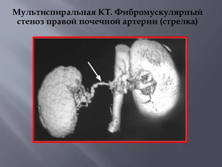 Мультиспиральная КТ. Фибромускулярный стеноз правой почечной артерии (стрелка)