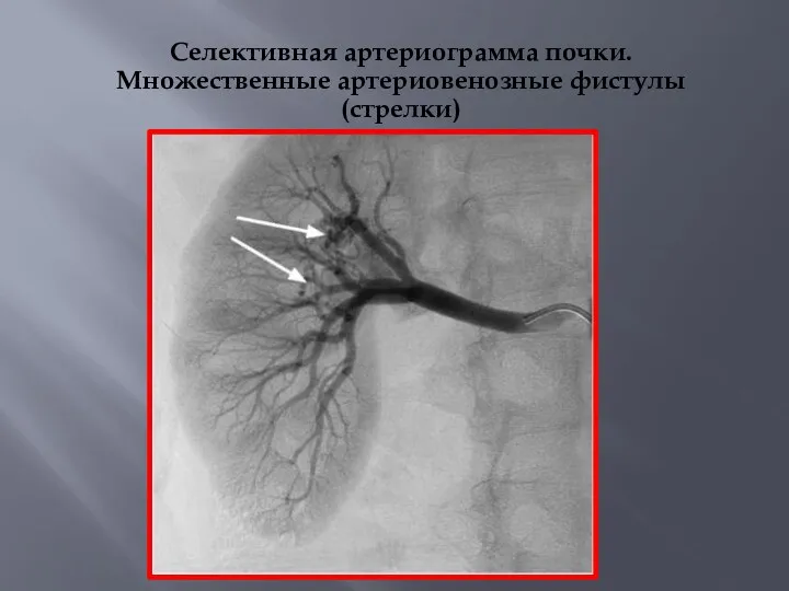 Селективная артериограмма почки. Множественные артериовенозные фистулы (стрелки)