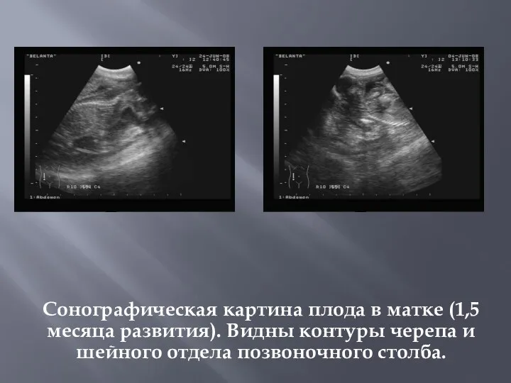 Сонографическая картина плода в матке (1,5 месяца развития). Видны контуры черепа и шейного отдела позвоночного столба.
