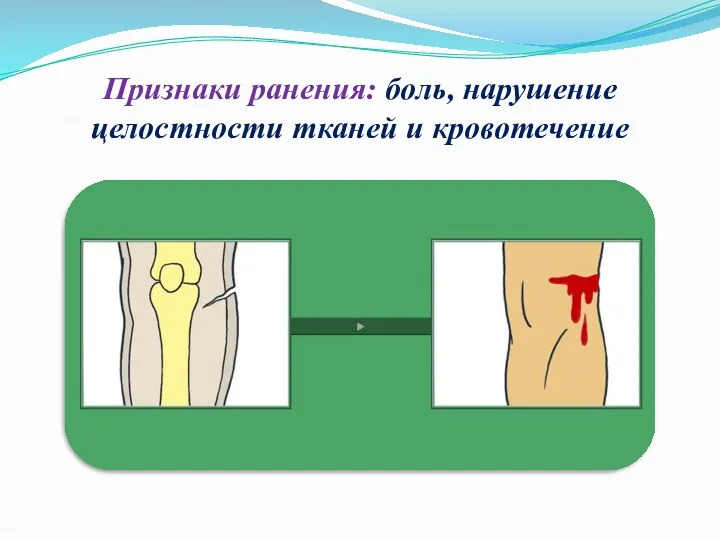 Признаки ранения: боль, нарушение целостности тканей и кровотечение