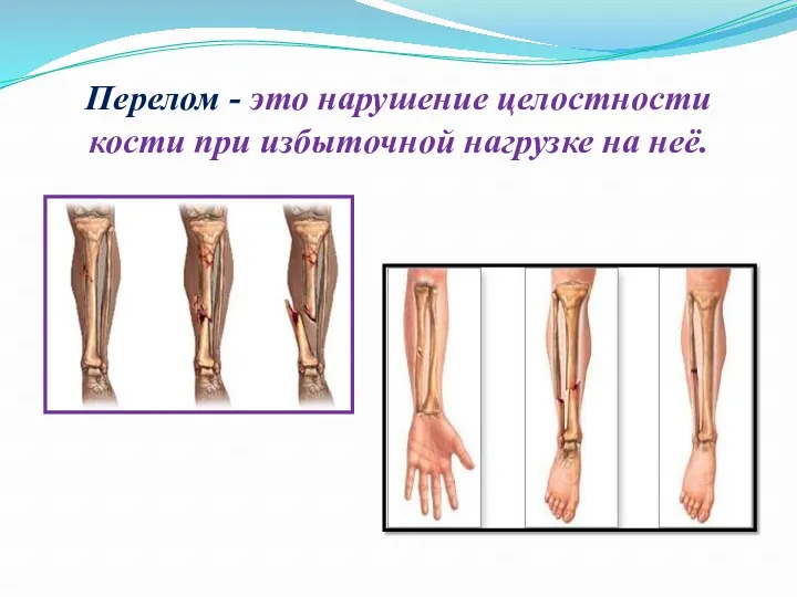 Перелом - это нарушение целостности кости при избыточной нагрузке на неё.