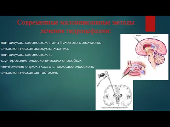 Современные малоинвазивные методы лечения гидроцефалии: вентрикулоцистерностомия дна III мозгового желудочка; эндоскопическая акведуктопластика; вентрикулоцистерностомия;