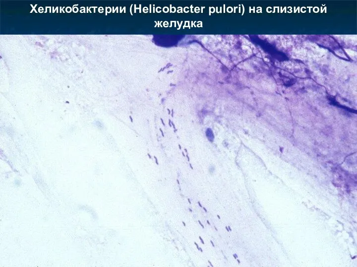 Хеликобактерии (Helicobacter pulori) на слизистой желудка