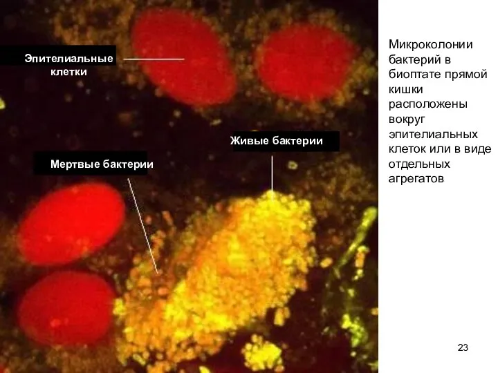 Микроколонии бактерий в биоптате прямой кишки расположены вокруг эпителиальных клеток или в виде