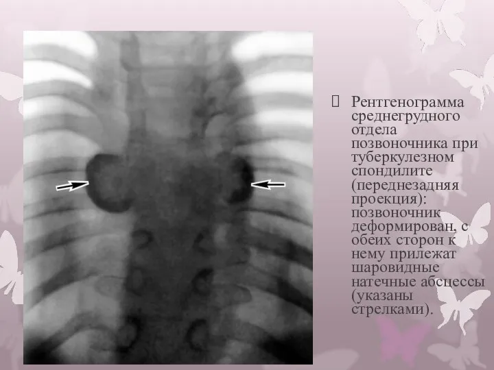Рентгенограмма среднегрудного отдела позвоночника при туберкулезном спондилите (переднезадняя проекция): позвоночник деформирован, с обеих