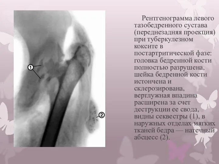 Рентгенограмма левого тазобедренного сустава (переднезадняя проекция) при туберкулезном коксите в постартритической фазе: головка