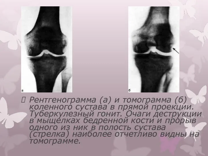 Рентгенограмма (а) и томограмма (б) коленного сустава в прямой проекции. Туберкулезный гонит. Очаги