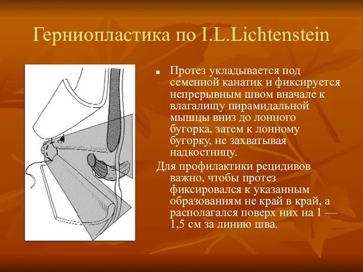 Герниопластика по I.L.Lichtenstein Протез укладывается под семенной канатик и фиксируется непрерывным швом вначале