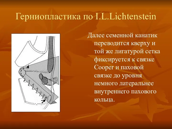 Герниопластика по I.L.Lichtenstein Далее семенной канатик переводится кверху и той же лигатурой сетка