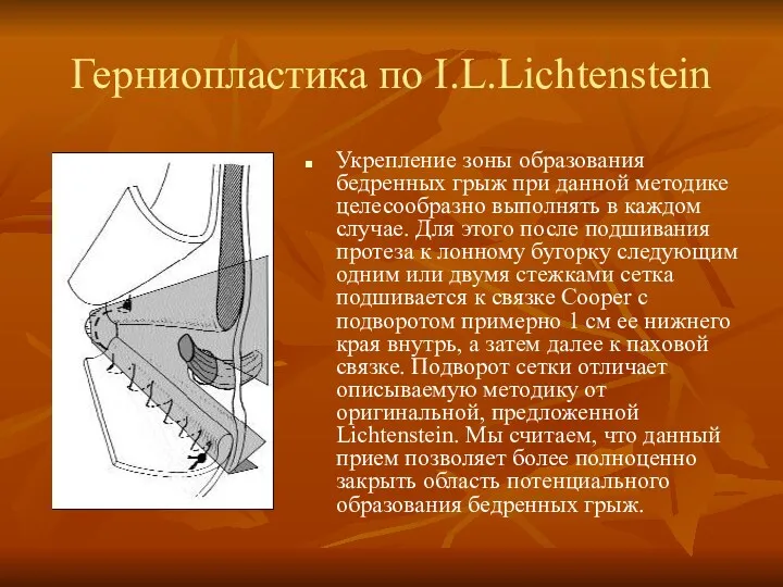 Герниопластика по I.L.Lichtenstein Укрепление зоны образования бедренных грыж при данной методике целесообразно выполнять