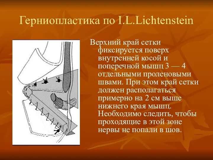 Герниопластика по I.L.Lichtenstein Верхний край сетки фиксируется поверх внутренней косой и поперечной мышц