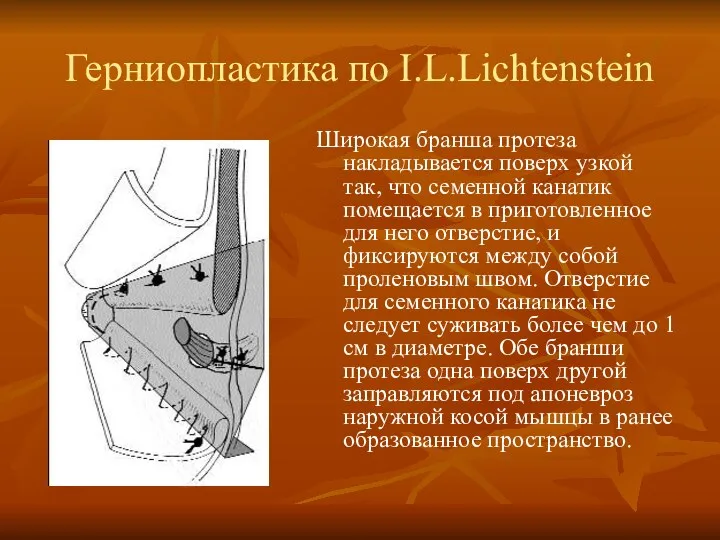 Герниопластика по I.L.Lichtenstein Широкая бранша протеза накладывается поверх узкой так,