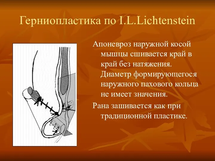Герниопластика по I.L.Lichtenstein Апоневроз наружной косой мышцы сшивается край в край без натяжения.