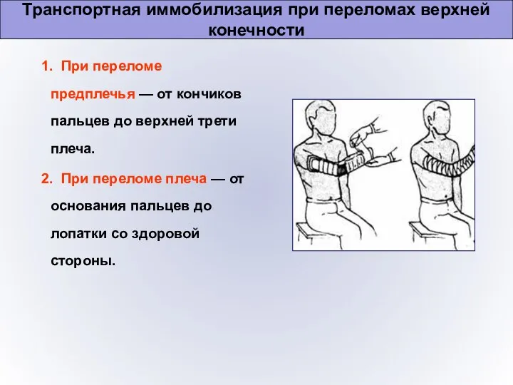 Транспортная иммобилизация при переломах верхней конечности 1. При переломе предплечья