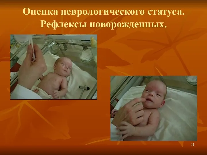 Оценка неврологического статуса. Рефлексы новорожденных.