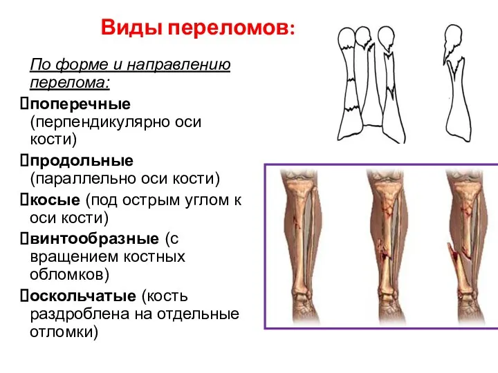 Виды переломов: По форме и направлению перелома: поперечные (перпендикулярно оси