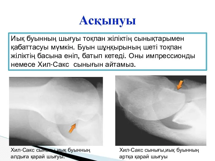 Асқынуы Хил-Сакс сынығы,иық буынның алдыға қарай шығуы. Хил-Сакс сынығы,иық буынның