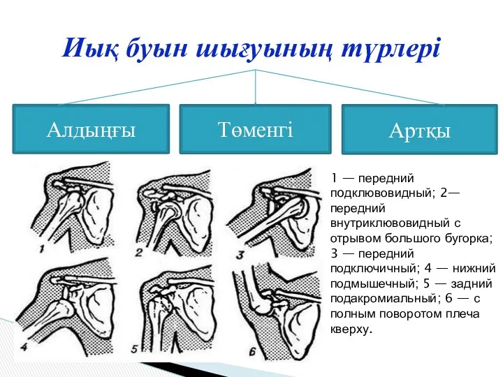 Иық буын шығуының түрлері Алдыңғы Артқы Төменгі 1 — передний