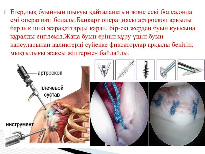 Егер,иық буынның шығуы қайталанатын және ескі болса,онда емі оперативті болады.Банкарт