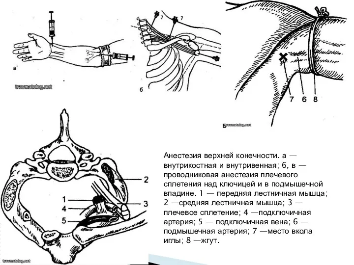 Анестезия верхней конечности. а — внутрикостная и внутривенная; 6, в