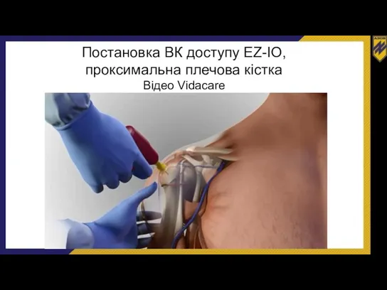 Постановка ВК доступу EZ-IO, проксимальна плечова кістка Відео Vidacare