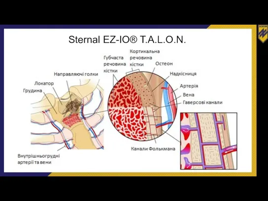 Sternal EZ-IO® T.A.L.O.N.