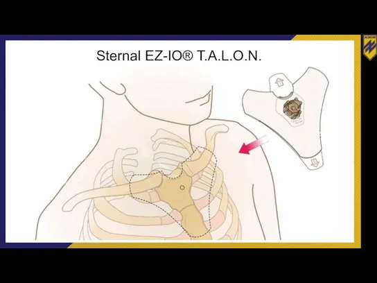 Sternal EZ-IO® T.A.L.O.N.