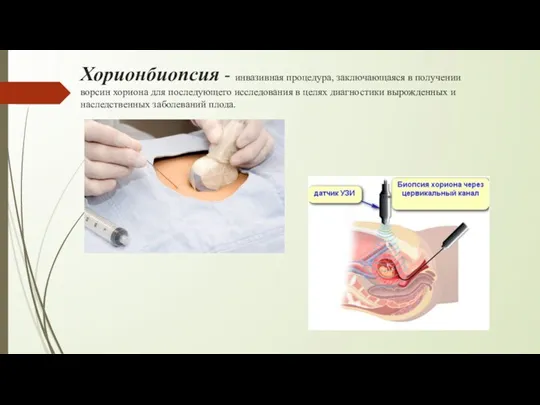 Хорионбиопсия - инвазивная процедура, заключающаяся в получении ворсин хориона для