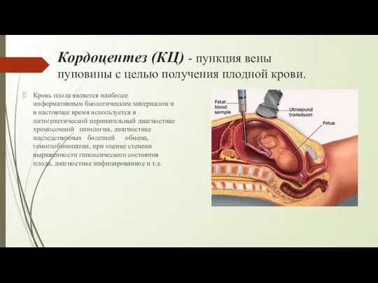 Кордоцентез (КЦ) - пункция вены пуповины с целью получения плодной