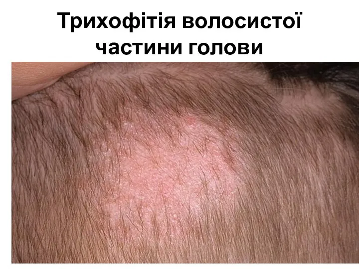 Трихофітія волосистої частини голови