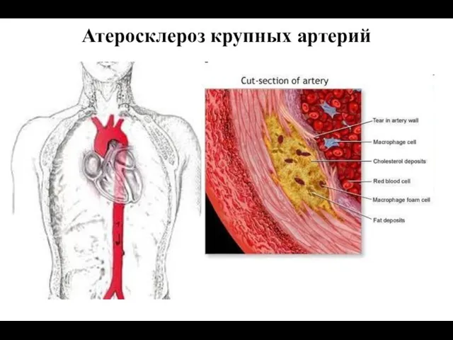 Атеросклероз крупных артерий