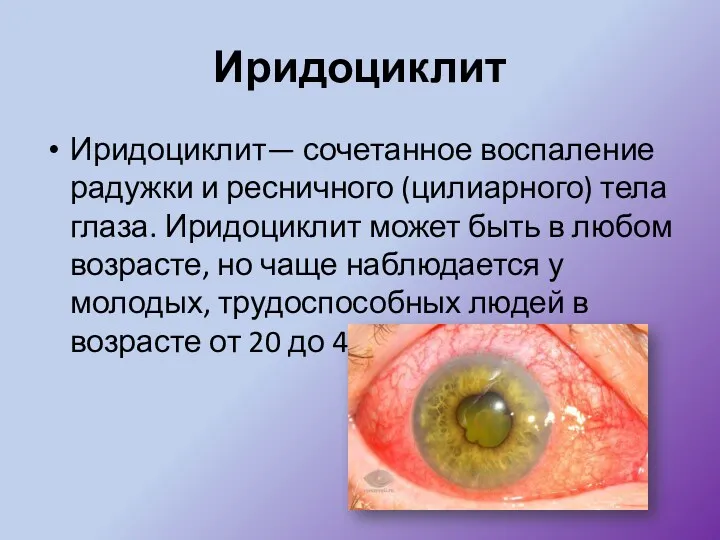 Иридоциклит Иридоциклит— сочетанное воспаление радужки и ресничного (цилиарного) тела глаза.