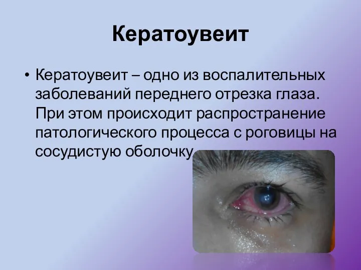 Кератоувеит Кератоувеит – одно из воспалительных заболеваний переднего отрезка глаза.