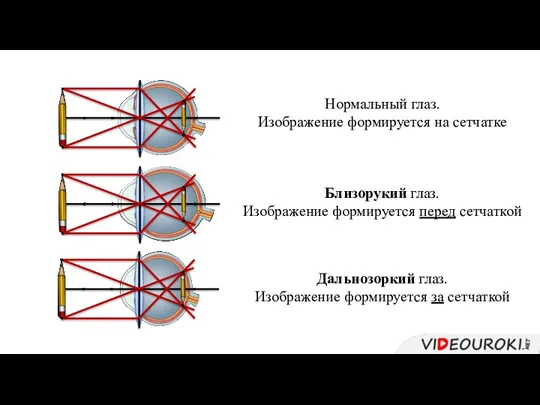 Нормальный глаз. Изображение формируется на сетчатке Близорукий глаз. Изображение формируется