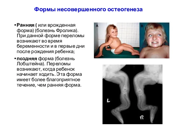 Формы несовершенного остеогенеза Ранняя ( или врожденная форма) (болезнь Фролика).