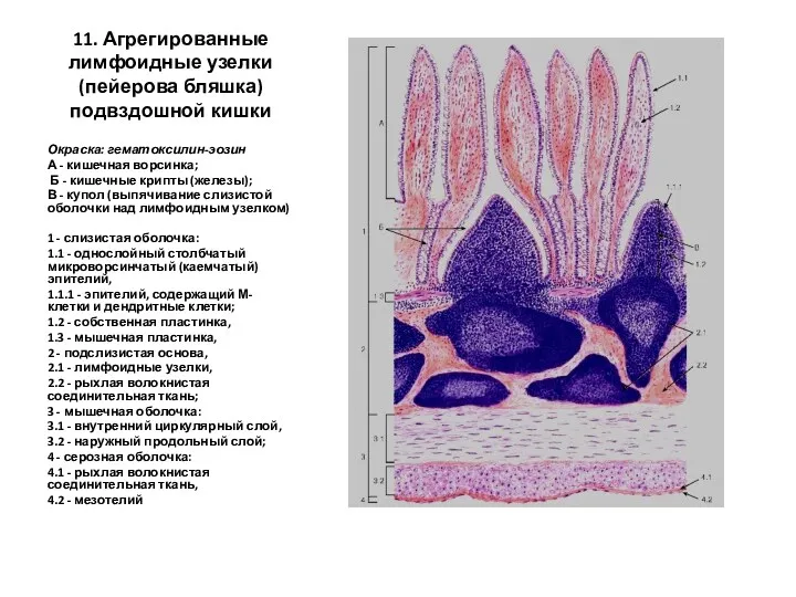 11. Агрегированные лимфоидные узелки (пейерова бляшка) подвздошной кишки Окраска: гематоксилин-эозин
