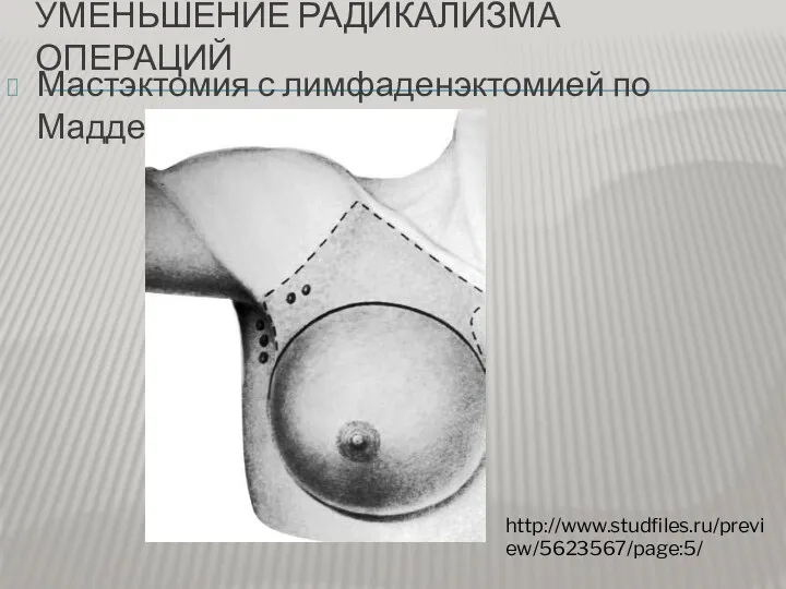 УМЕНЬШЕНИЕ РАДИКАЛИЗМА ОПЕРАЦИЙ Мастэктомия с лимфаденэктомией по Маддену http://www.studfiles.ru/preview/5623567/page:5/