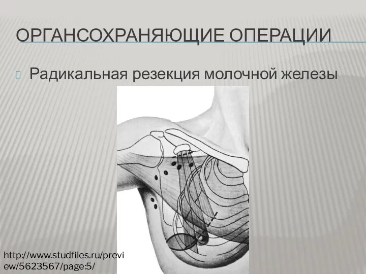 ОРГАНСОХРАНЯЮЩИЕ ОПЕРАЦИИ Радикальная резекция молочной железы http://www.studfiles.ru/preview/5623567/page:5/