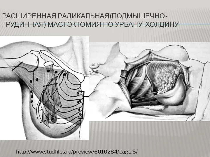 РАСШИРЕННАЯ РАДИКАЛЬНАЯ(ПОДМЫШЕЧНО-ГРУДИННАЯ) МАСТЭКТОМИЯ ПО УРБАНУ-ХОЛДИНУ http://www.studfiles.ru/preview/6010284/page:5/