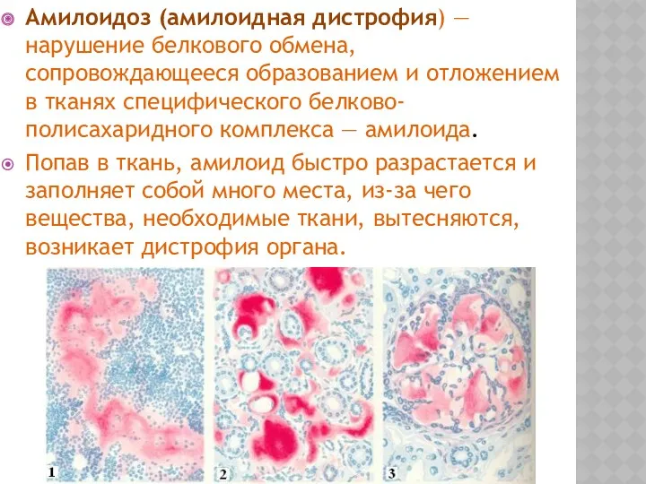 Амилоидоз (амилоидная дистрофия) — нарушение белкового обмена, сопровождающееся образованием и