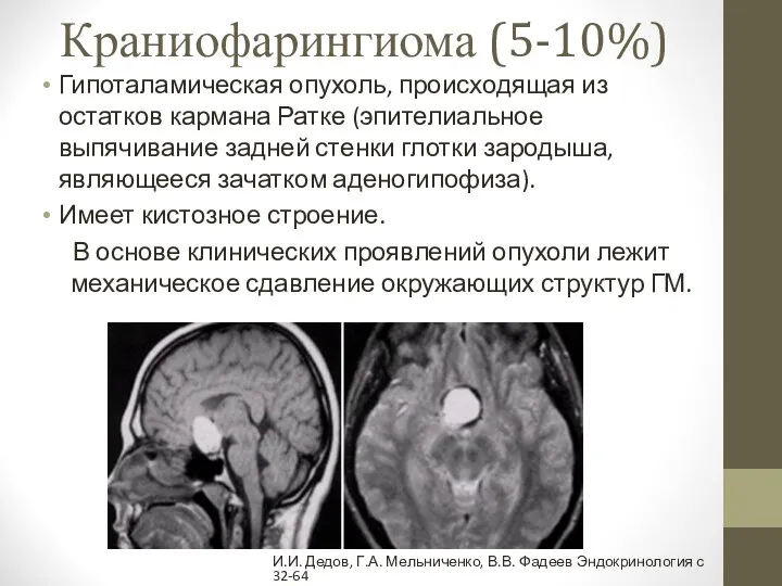 Краниофарингиома (5-10%) Гипоталамическая опухоль, происходящая из остатков кармана Ратке (эпителиальное