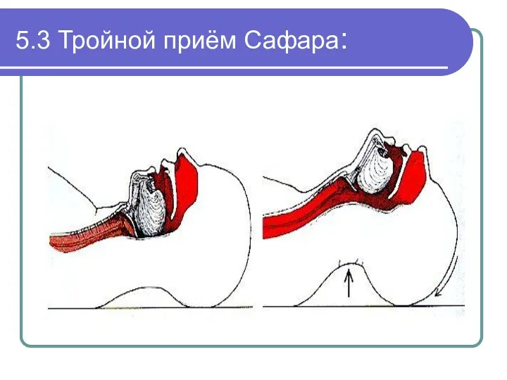 5.3 Тройной приём Сафара: