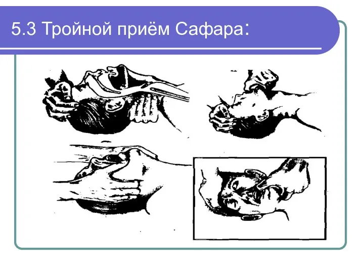 5.3 Тройной приём Сафара: