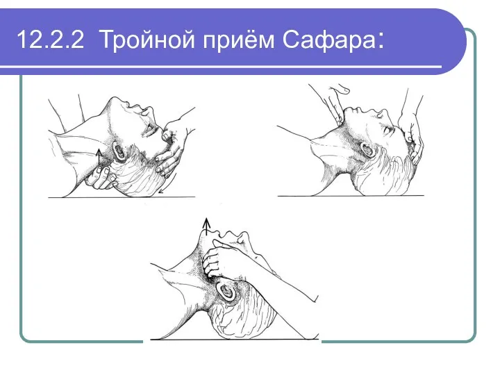 12.2.2 Тройной приём Сафара: