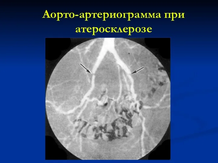 Аорто-артериограмма при атеросклерозе