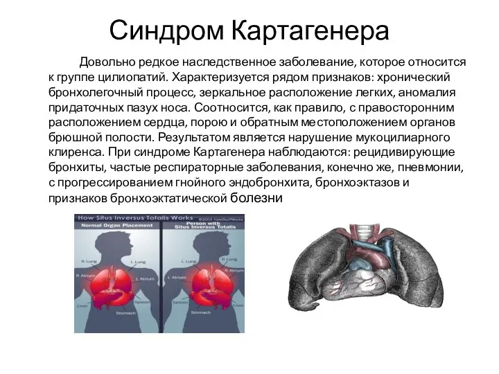 Синдром Картагенера Довольно редкое наследственное заболевание, которое относится к группе